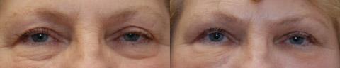 Fat Transfer Before and After Photos in Cincinnati, OH, Patient 5718