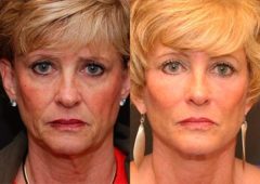 Fat Transfer Before and After Photos in Cincinnati, OH, Patient 5723