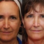 Fat Transfer Before and After Photos in Cincinnati, OH, Patient 5728
