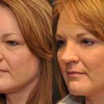 Fat Transfer Before and After Photos in Cincinnati, OH, Patient 5733