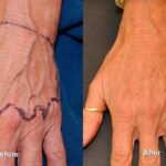 Fat Transfer Before and After Photos in Cincinnati, OH, Patient 5738