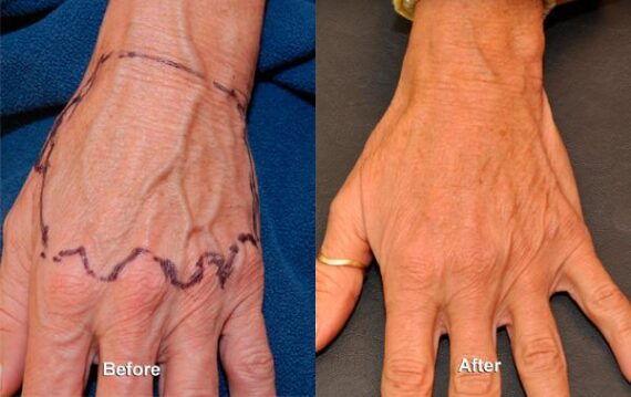 Fat Transfer Before and After Photos in Cincinnati, OH, Patient 5738