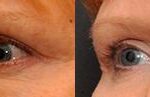 Fat Transfer Before and After Photos in Cincinnati, OH, Patient 5748