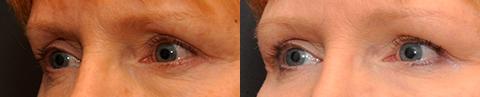 Fat Transfer Before and After Photos in Cincinnati, OH, Patient 5748