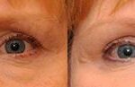 Fat Transfer Before and After Photos in Cincinnati, OH, Patient 5748