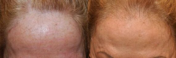 Hair Transplantation Before and After Photos in Cincinnati, OH