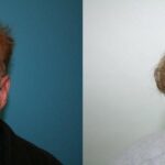 Hair Transplantation Before and After Photos in Cincinnati, OH, Patient 5756