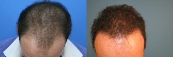 Hair Transplantation Before and After Photos in Cincinnati, OH, Patient 5759