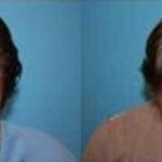 Hair Transplantation Before and After Photos in Cincinnati, OH, Patient 5762