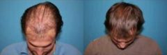 Hair Transplantation Before and After Photos in Cincinnati, OH, Patient 5762