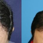 Hair Transplantation Before and After Photos in Cincinnati, OH, Patient 5765