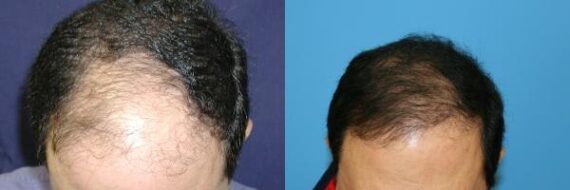 Hair Transplantation Before and After Photos in Cincinnati, OH, Patient 5765
