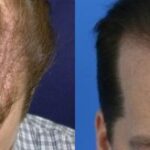 Hair Transplantation Before and After Photos in Cincinnati, OH, Patient 5771