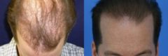 Hair Transplantation Before and After Photos in Cincinnati, OH, Patient 5771