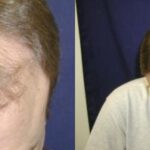 Hair Transplantation Before and After Photos in Cincinnati, OH, Patient 5774