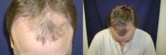 Hair Transplantation Before and After Photos in Cincinnati, OH, Patient 5774