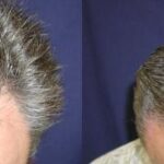 Hair Transplantation Before and After Photos in Cincinnati, OH, Patient 5780