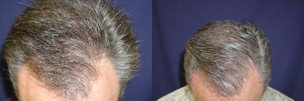 Hair Transplantation Before and After Photos in Cincinnati, OH, Patient 5780