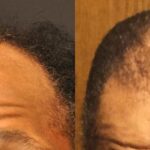 Hair Transplantation Before and After Photos in Cincinnati, OH, Patient 5788