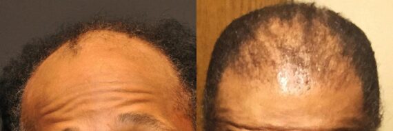 Hair Transplantation Before and After Photos in Cincinnati, OH, Patient 5788