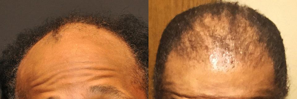 Hair Transplantation Before and After Photos in Cincinnati, OH, Patient 5788