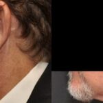 Hair Transplantation Before and After Photos in Cincinnati, OH, Patient 5794