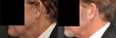 Hair Transplantation Before and After Photos in Cincinnati, OH, Patient 5794