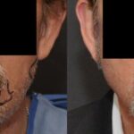 Hair Transplantation Before and After Photos in Cincinnati, OH, Patient 5794