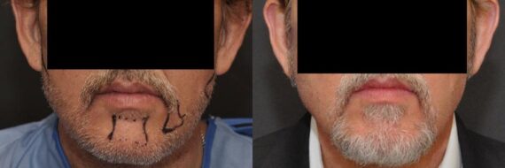 Hair Transplantation Before and After Photos in Cincinnati, OH, Patient 5794