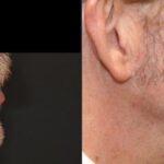 Hair Transplantation Before and After Photos in Cincinnati, OH, Patient 5794