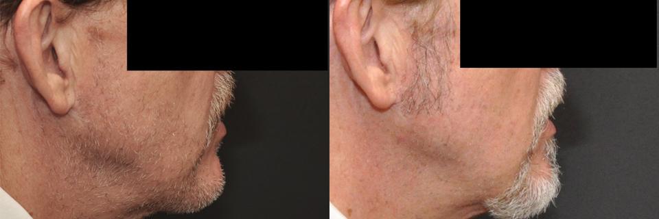 Hair Transplantation Before and After Photos in Cincinnati, OH, Patient 5794