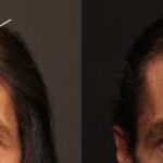Hair Transplantation Before and After Photos in Cincinnati, OH, Patient 5801