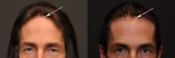 Hair Transplantation Before and After Photos in Cincinnati, OH, Patient 5801