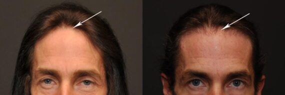 Hair Transplantation Before and After Photos in Cincinnati, OH, Patient 5801