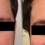 Hair Transplantation Before and After Photos in Cincinnati, OH, Patient 5804