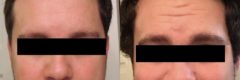 Hair Transplantation Before and After Photos in Cincinnati, OH, Patient 5804