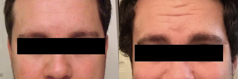 Hair Transplantation Before and After Photos in Cincinnati, OH, Patient 5804