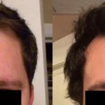 Hair Transplantation Before and After Photos in Cincinnati, OH, Patient 5804