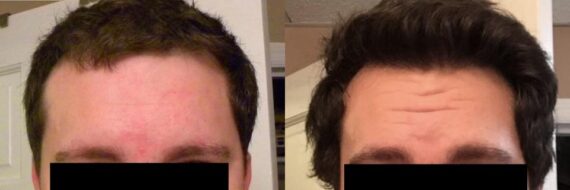 Hair Transplantation Before and After Photos in Cincinnati, OH, Patient 5804
