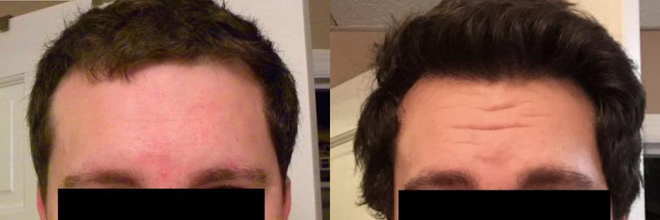 Hair Transplantation Before and After Photos in Cincinnati, OH, Patient 5804