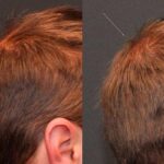 Hair Transplantation Before and After Photos in Cincinnati, OH, Patient 5809