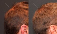 Hair Transplantation Before and After Photos in Cincinnati, OH, Patient 5809