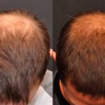 Hair Transplantation Before and After Photos in Cincinnati, OH, Patient 5809
