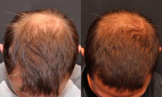 Hair Transplantation Before and After Photos in Cincinnati, OH, Patient 5809