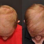 Hair Transplantation Before and After Photos in Cincinnati, OH, Patient 5814