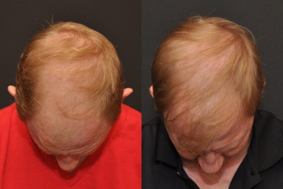 Hair Transplantation Before and After Photos in Cincinnati, OH, Patient 5814