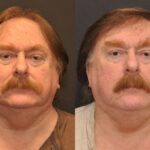 Hair Transplantation Before and After Photos in Cincinnati, OH, Patient 5817