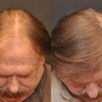 Hair Transplantation Before and After Photos in Cincinnati, OH, Patient 5817