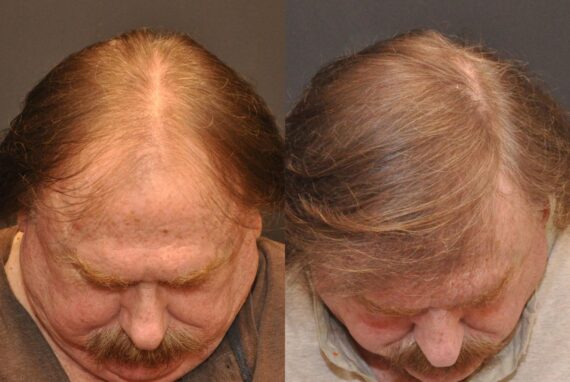 Hair Transplantation Before and After Photos in Cincinnati, OH, Patient 5817
