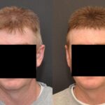 Hair Transplantation Before and After Photos in Cincinnati, OH, Patient 5822